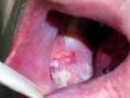 /album/oral-cancer/oral-cancer-3-jpg/